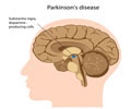 Parkinson  Hastal